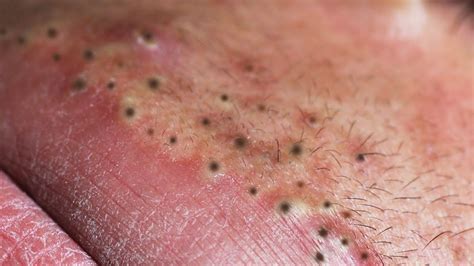 😱😱😱 If you've ever had an inflamed pimple or blackheads, you know what pain in a room feels like. In this video you can see the removal of a large inflame...